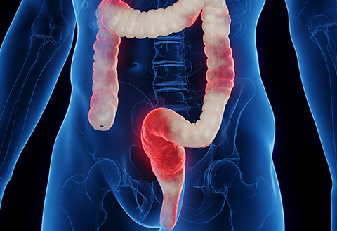 Westmedicum Gastroenterologie Kontrolle nach Sigmadivertikulitis